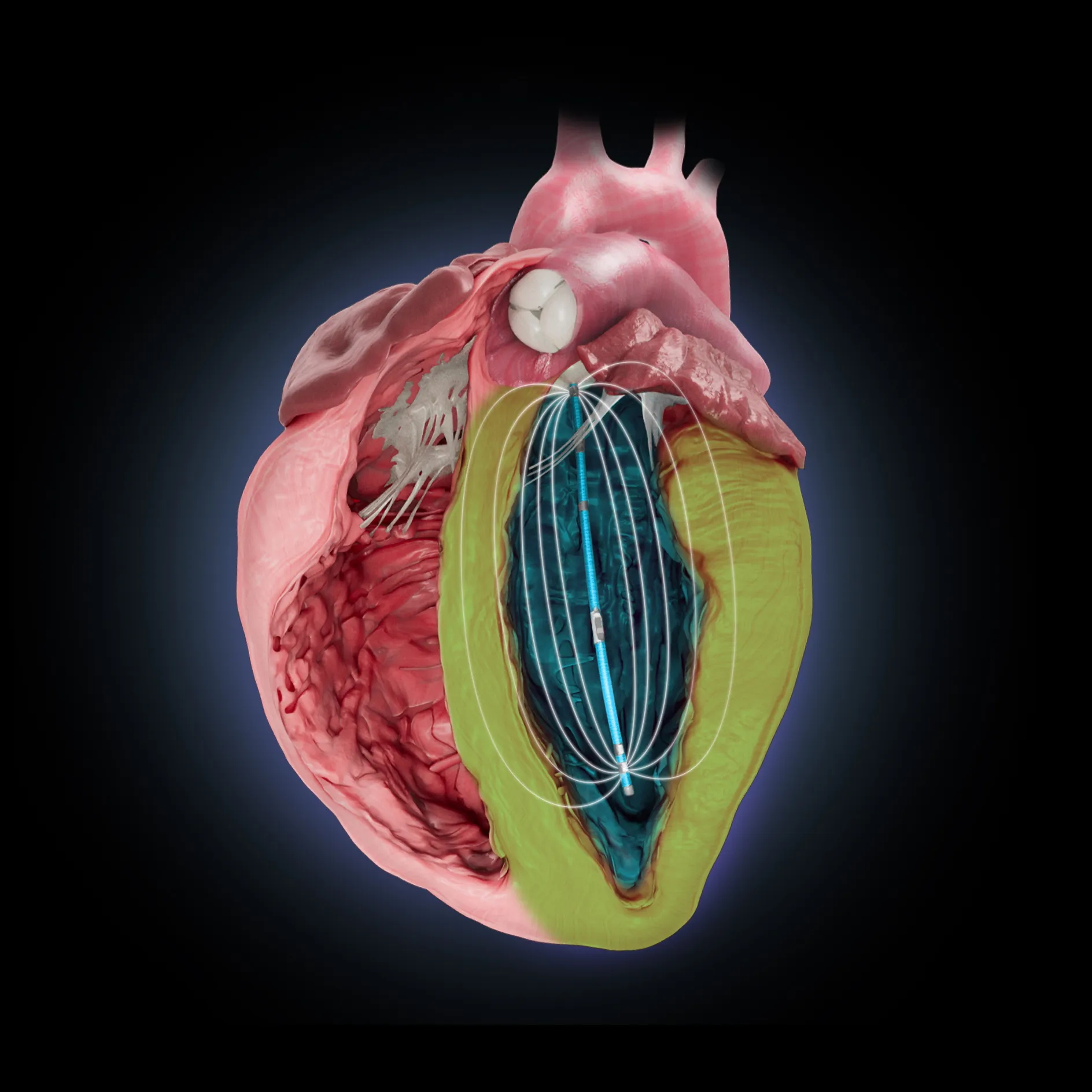 Transonic Heart Left Ventricle - cut away