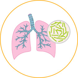 Sepsis stages